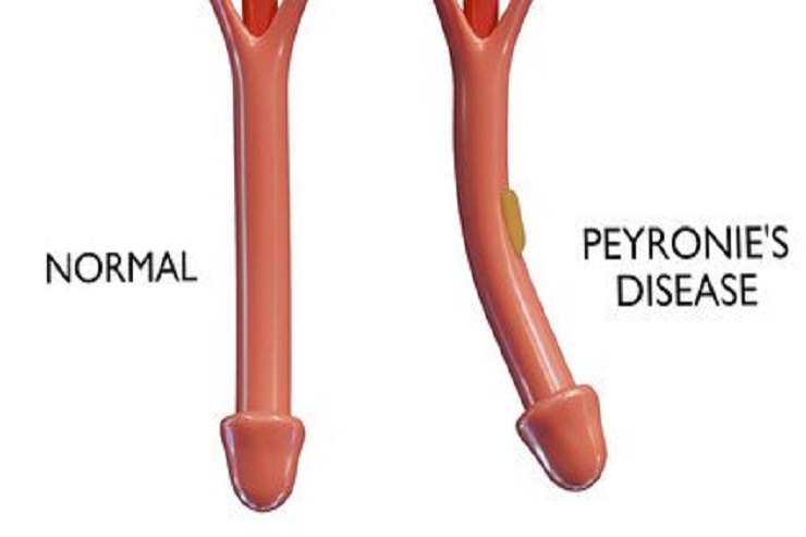 peyronies disease near me in orlando