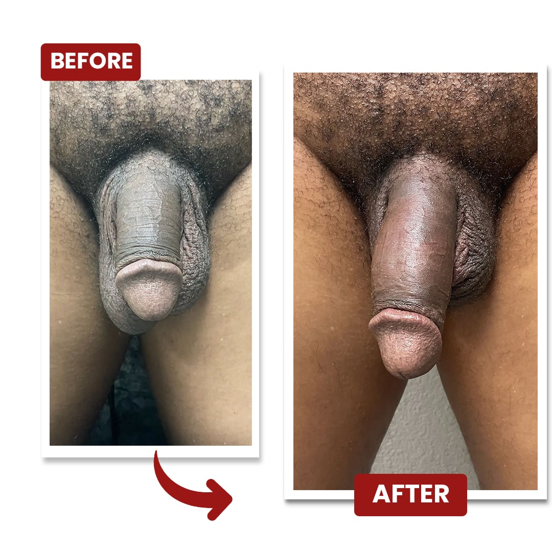 erectionclinic - Banner - BEFORE AFTER (i)-min